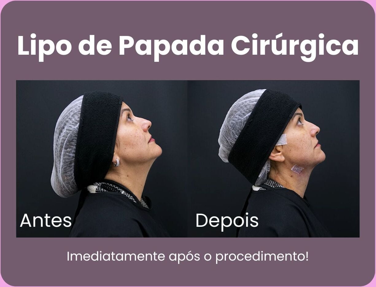 Lipo de Papada Cirúrgica Jardim das Américas Curitiba l Clínicas Nepuga