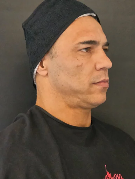 Antes — Harmonização Facial