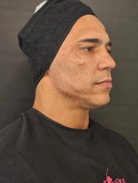Depois — Harmonização Facial