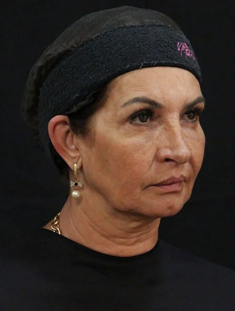 Antes — Harmonização Facial