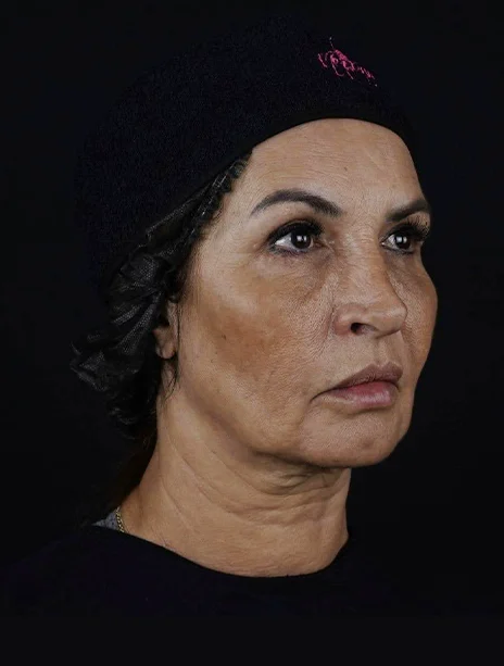 Depois — Harmonização Facial
