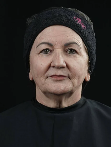 Antes — Harmonização Facial