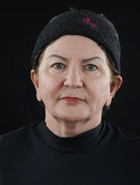 Depois — Harmonização Facial
