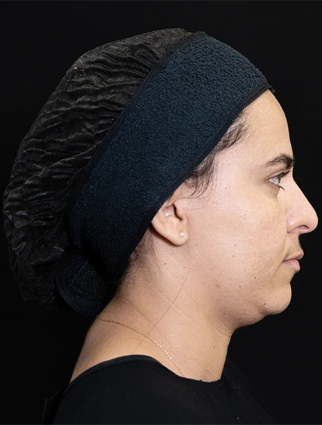 Antes — Harmonização Facial