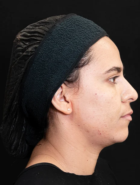 Depois — Harmonização Facial