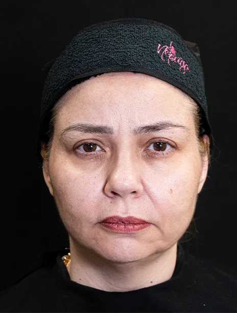 Antes — Harmonização Facial