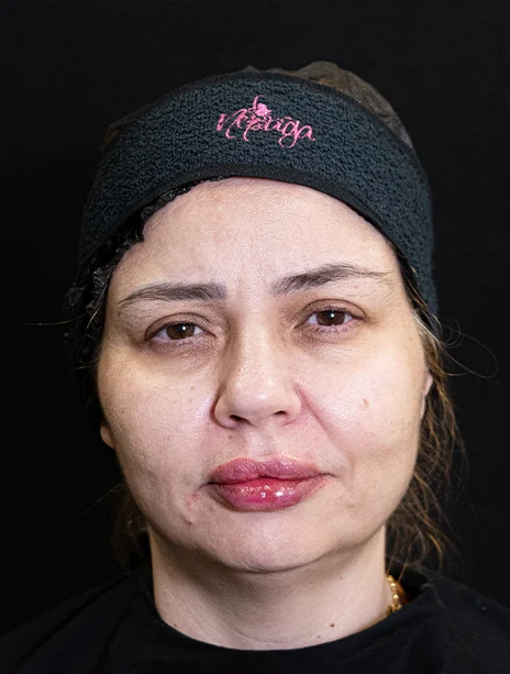 Depois — Harmonização Facial