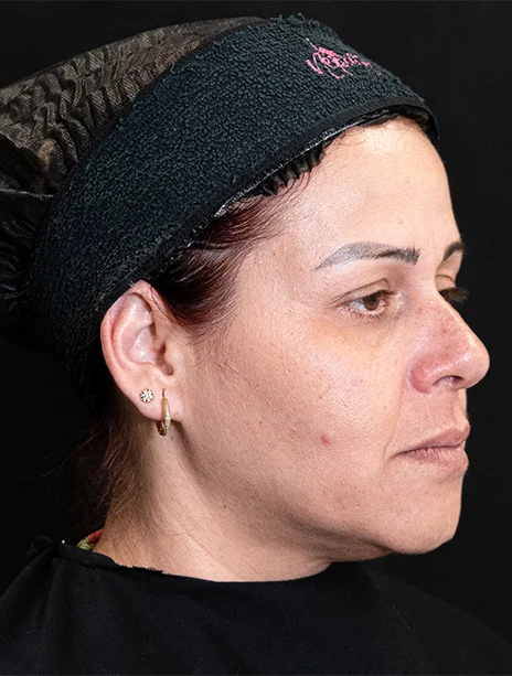 Antes — Harmonização Facial