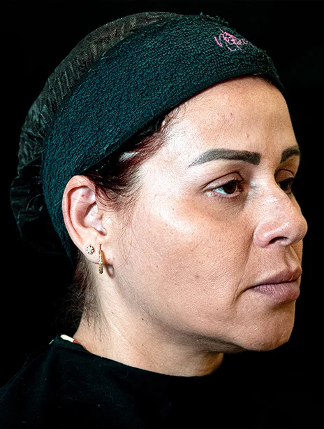 Depois — Harmonização Facial