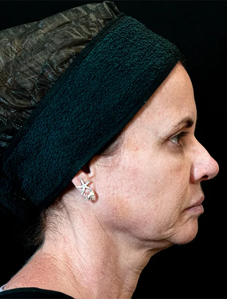 Antes — Harmonização Facial