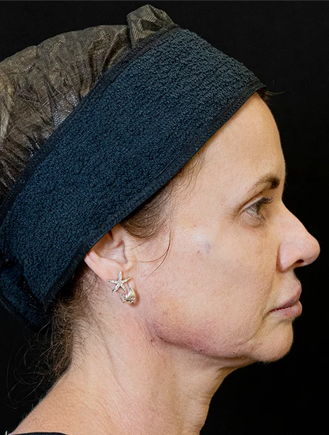Depois — Harmonização Facial