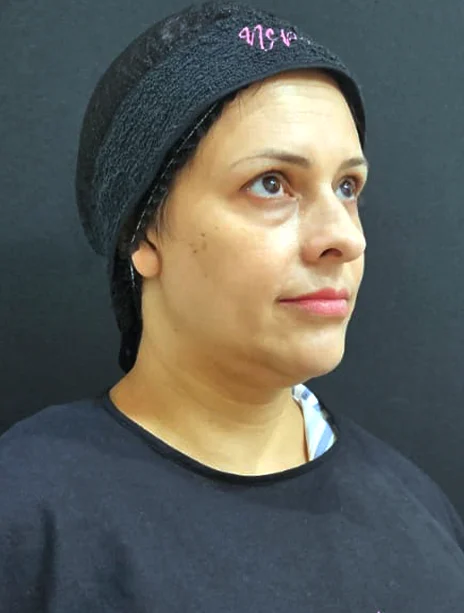Antes — Preenchimento