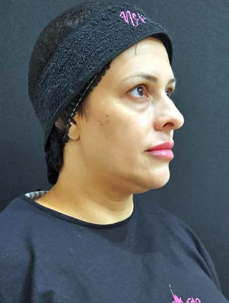 Depois — Preenchimento