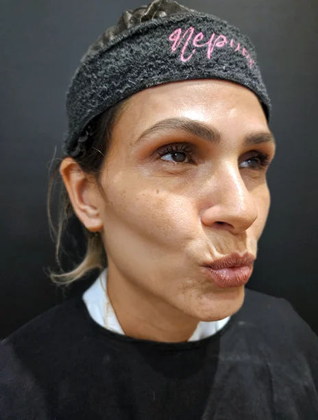 Depois — Preenchimento