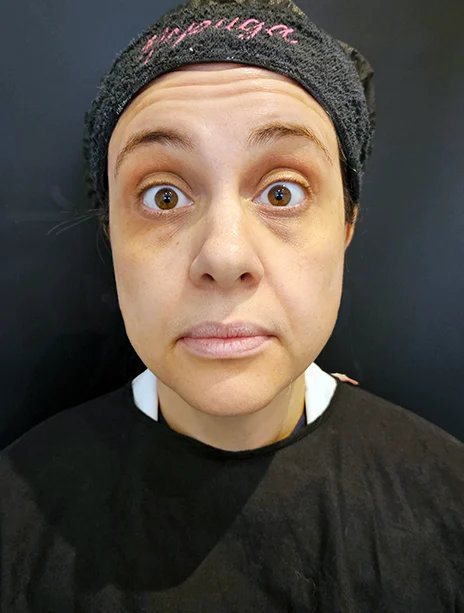 Antes — Toxina Botulínica