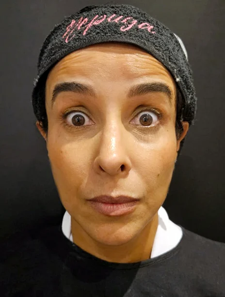 Antes — Toxina Botulínica