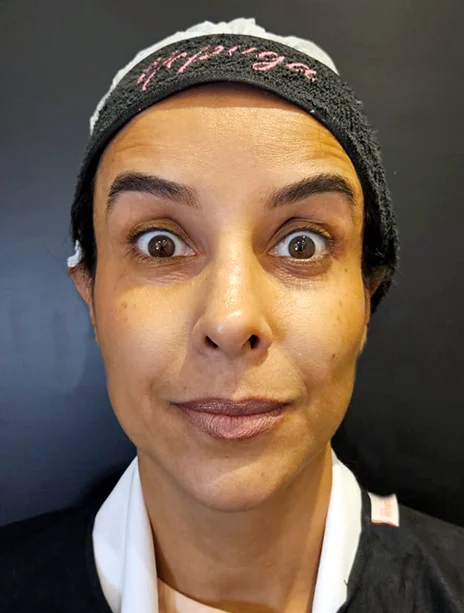 Depois — Toxina Botulínica