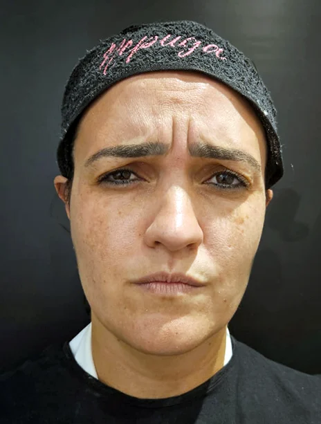 Antes — Toxina Botulínica