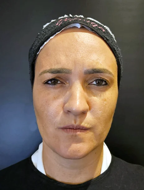 Depois — Toxina Botulínica