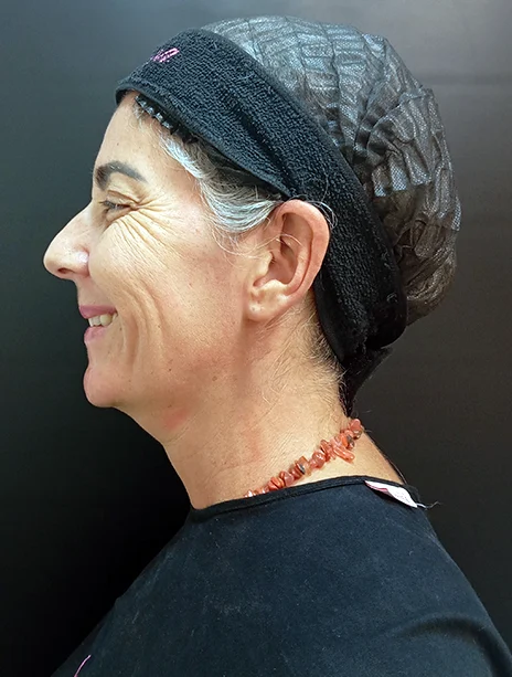 Antes — Toxina Botulínica