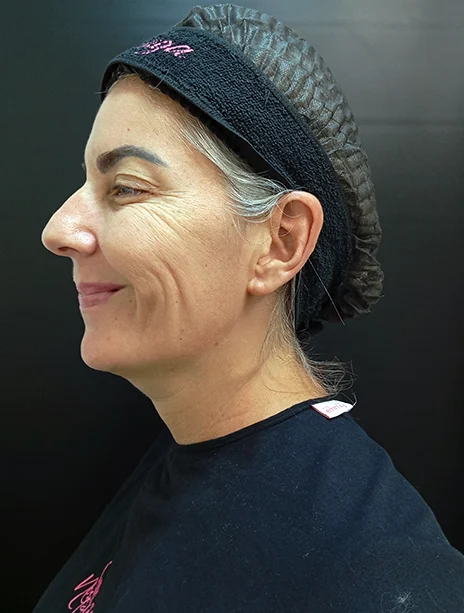 Depois — Toxina Botulínica
