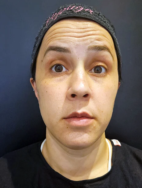 Antes — Toxina Botulínica