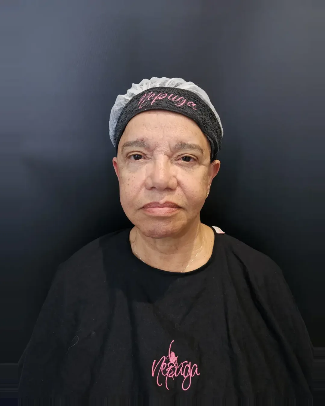 Antes — Bioestimulador de Colágeno — Facial