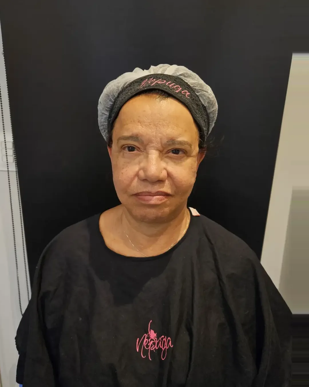 Depois — Bioestimulador de Colágeno — Facial