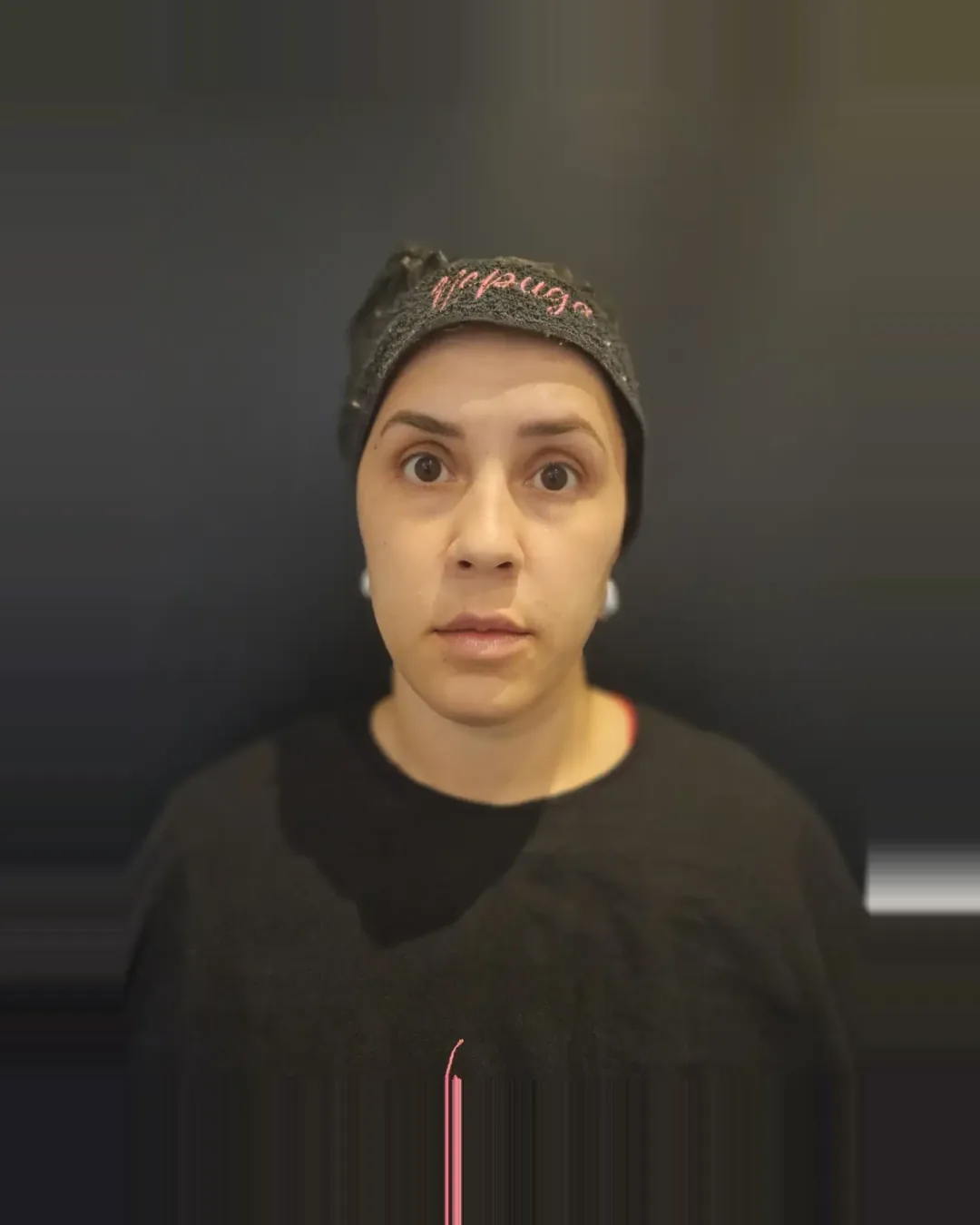 Depois — Toxina Botulínica — Testa