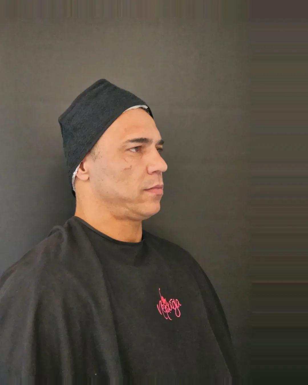 Antes — Harmonização — Facial