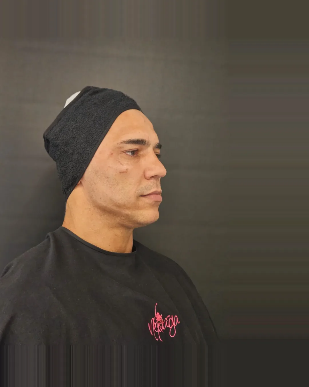 Depois — Harmonização — Facial