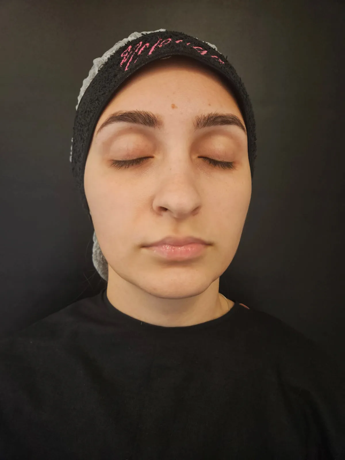 Antes — Preenchimento — Área Labial