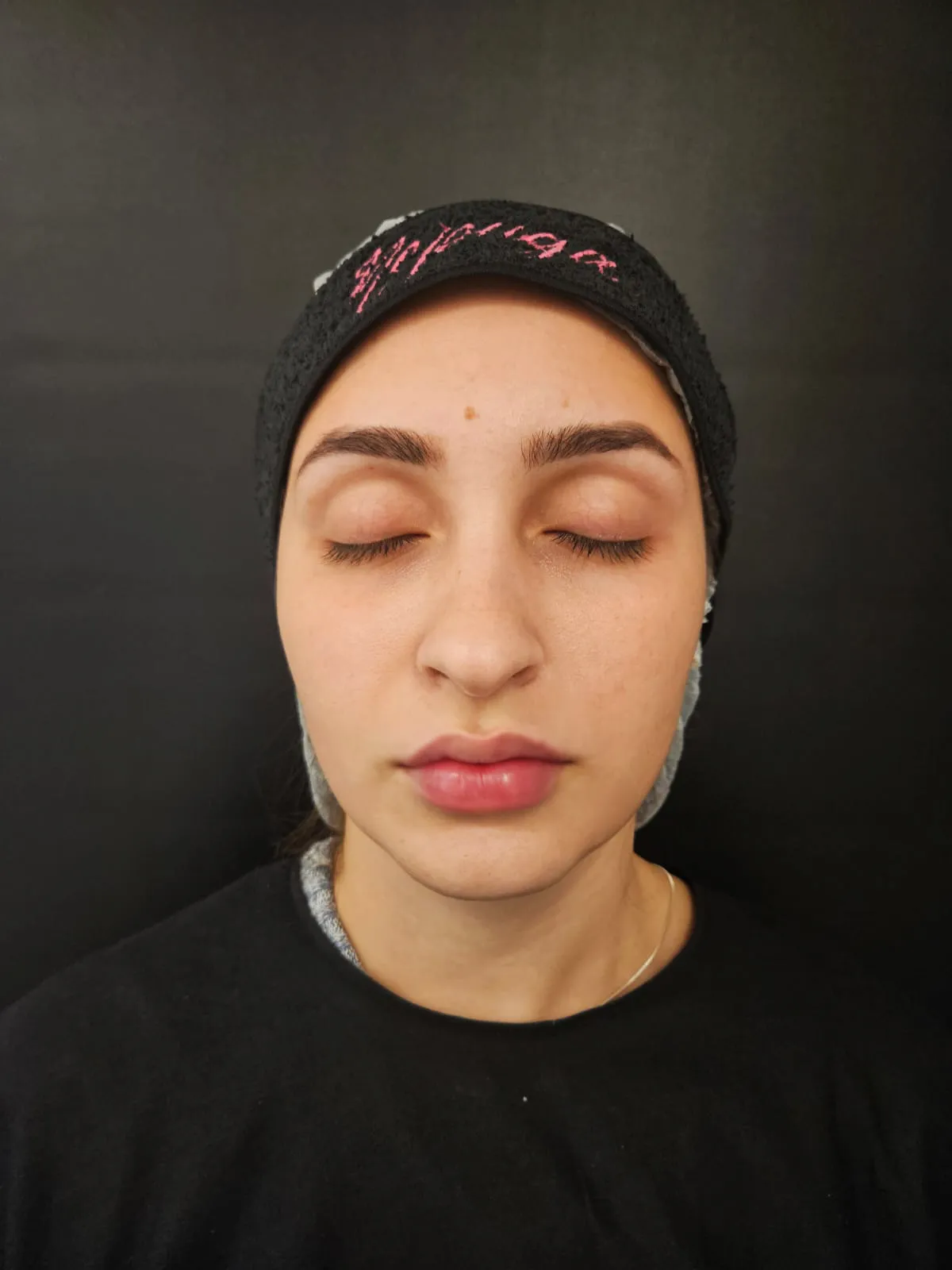 Depois — Preenchimento — Área Labial